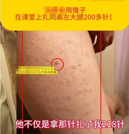校園防欺凌報警器：“女生被同桌扎218針”，未達到校園霸凌標準？多方回應